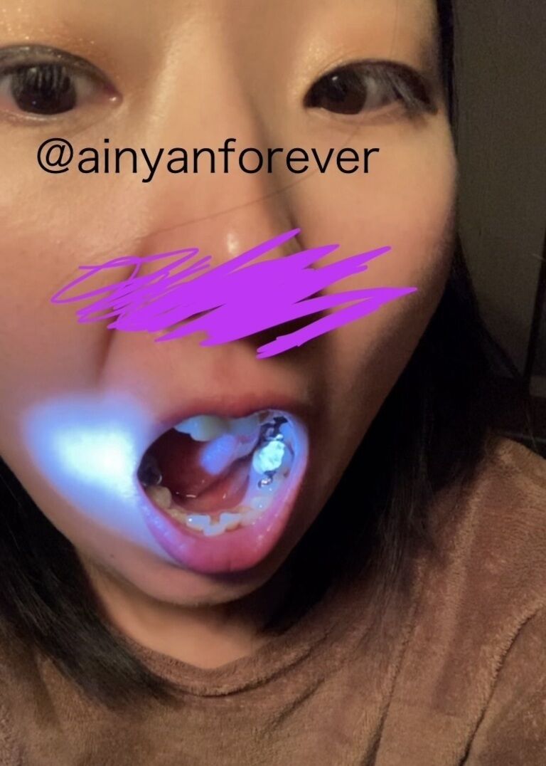 虫歯治療中